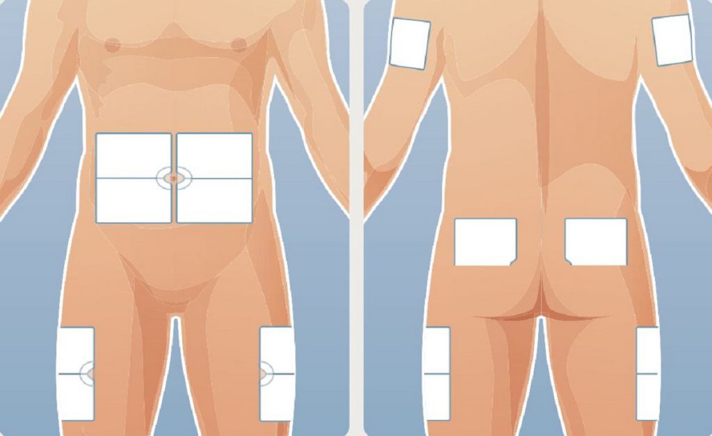 abdomen, cuisses, fesses, insuline